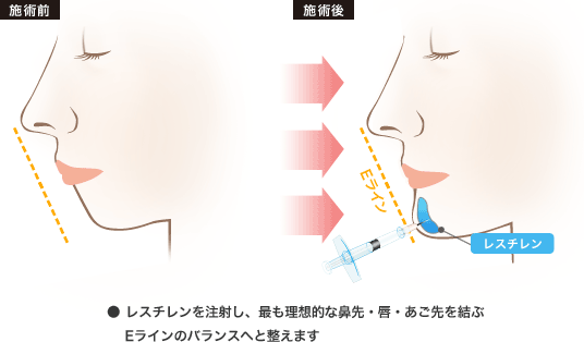 レスチレンを注射し、最も理想的な鼻先・唇・あご先を結ぶEラインのバランスへと整えます